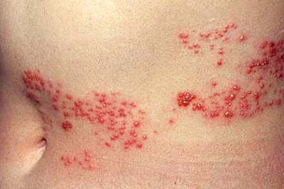 Shingles (herpes zoster)